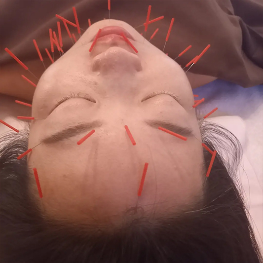 姫さま美容鍼(筋膜美容鍼)10,000円